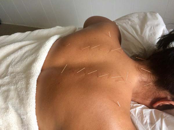 Acupunture Photo 1